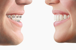 traditional-braces-versus-Invisalign-clear-aligners